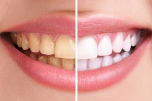 Blanqueamiento dental en Javea
