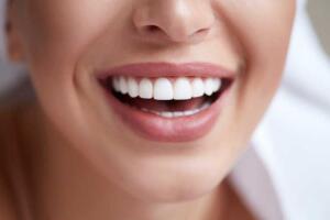 Carillas dentales en Javea