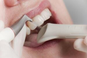 Descalcificación y limpieza dental en Javea