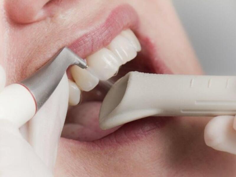 Descalcificación y limpieza dental en Javea